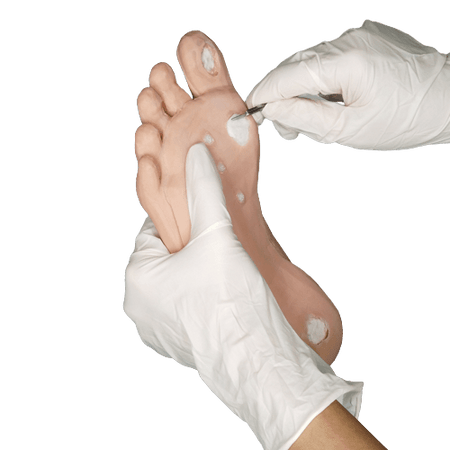 Corn and Callus debridement trainer - Medimodels