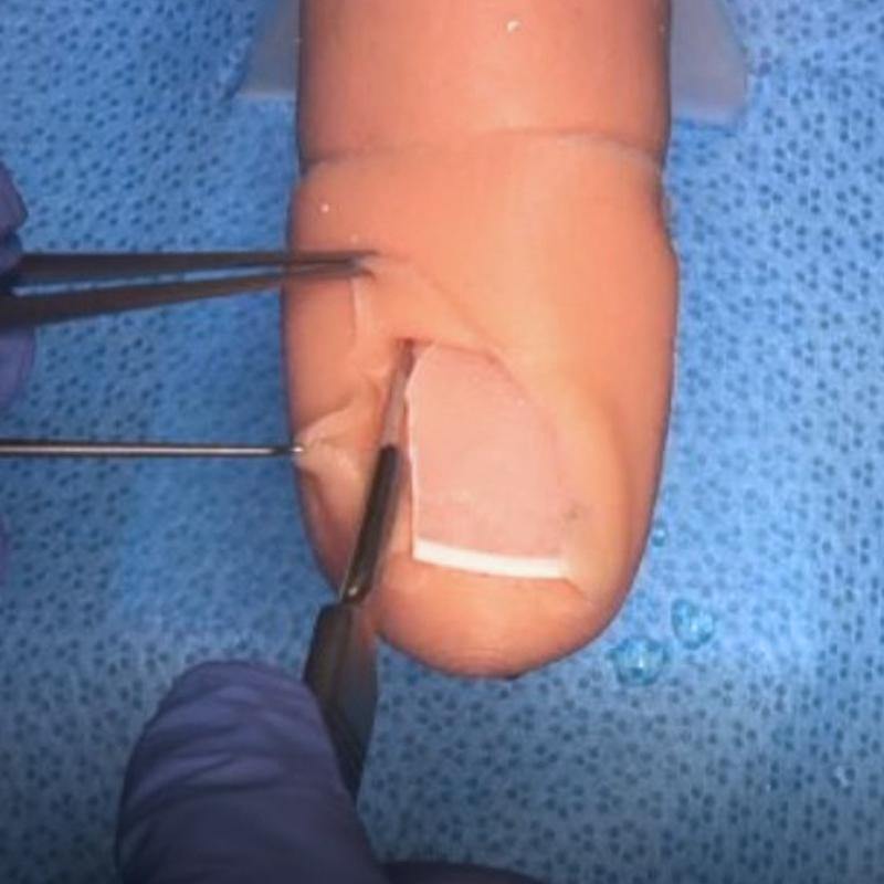 Ingrown toenail simulator - training clinic 'starter kit' - Medimodels