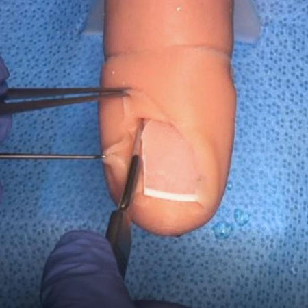 Ingrown toenail simulator - training clinic 'starter kit' - Medimodels